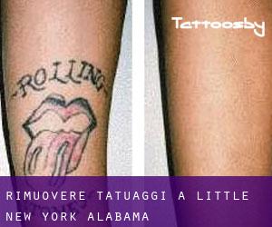 Rimuovere Tatuaggi a Little New York (Alabama)