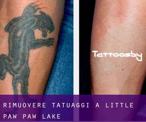 Rimuovere Tatuaggi a Little Paw Paw Lake
