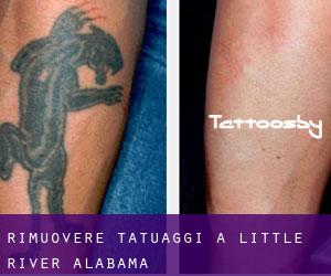 Rimuovere Tatuaggi a Little River (Alabama)