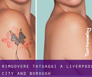 Rimuovere Tatuaggi a Liverpool (City and Borough)