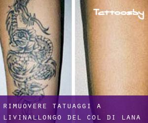 Rimuovere Tatuaggi a Livinallongo del Col di Lana