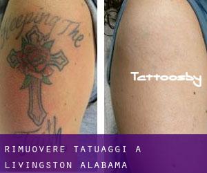 Rimuovere Tatuaggi a Livingston (Alabama)