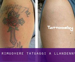 Rimuovere Tatuaggi a Llandenny