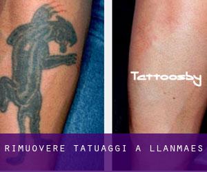 Rimuovere Tatuaggi a Llanmaes