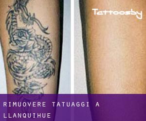 Rimuovere Tatuaggi a Llanquihue