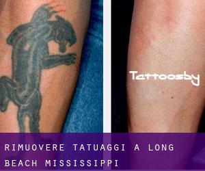 Rimuovere Tatuaggi a Long Beach (Mississippi)
