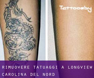 Rimuovere Tatuaggi a Longview (Carolina del Nord)