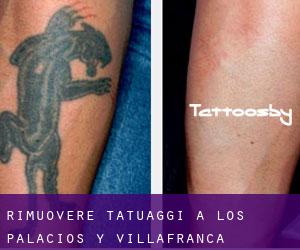 Rimuovere Tatuaggi a Los Palacios y Villafranca