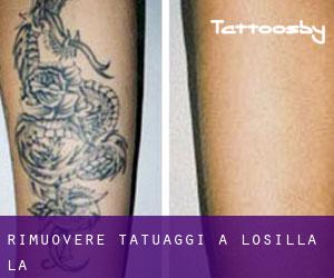 Rimuovere Tatuaggi a Losilla (La)
