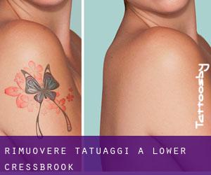 Rimuovere Tatuaggi a Lower Cressbrook