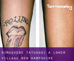 Rimuovere Tatuaggi a Lower Village (New Hampshire)