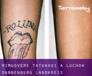 Rimuovere Tatuaggi a Lüchow-Dannenberg Landkreis