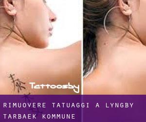 Rimuovere Tatuaggi a Lyngby-Tårbæk Kommune
