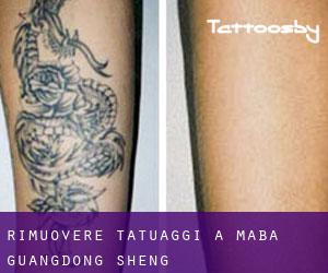 Rimuovere Tatuaggi a Maba (Guangdong Sheng)