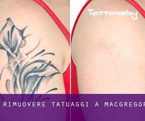 Rimuovere Tatuaggi a Macgregor