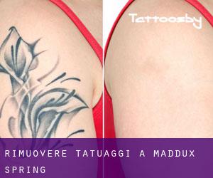 Rimuovere Tatuaggi a Maddux Spring
