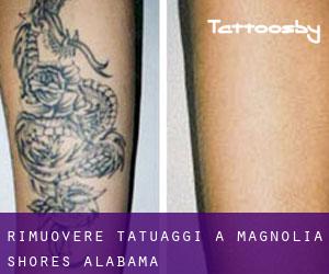 Rimuovere Tatuaggi a Magnolia Shores (Alabama)
