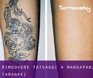 Rimuovere Tatuaggi a Mangapani (Taranaki)
