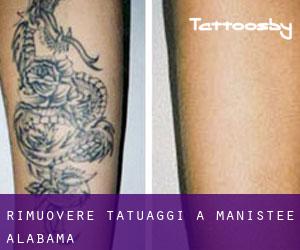 Rimuovere Tatuaggi a Manistee (Alabama)