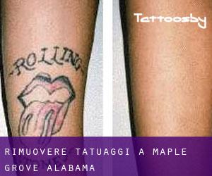 Rimuovere Tatuaggi a Maple Grove (Alabama)
