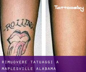 Rimuovere Tatuaggi a Maplesville (Alabama)