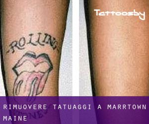 Rimuovere Tatuaggi a Marrtown (Maine)