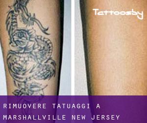 Rimuovere Tatuaggi a Marshallville (New Jersey)