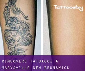 Rimuovere Tatuaggi a Marysville (New Brunswick)