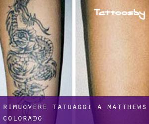 Rimuovere Tatuaggi a Matthews (Colorado)