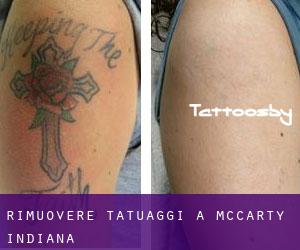 Rimuovere Tatuaggi a McCarty (Indiana)