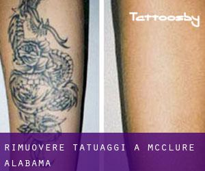 Rimuovere Tatuaggi a McClure (Alabama)