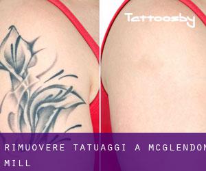 Rimuovere Tatuaggi a McGlendon Mill
