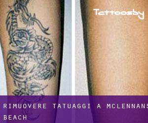 Rimuovere Tatuaggi a McLennan's Beach