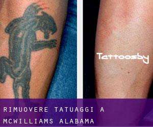 Rimuovere Tatuaggi a McWilliams (Alabama)