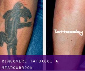 Rimuovere Tatuaggi a Meadowbrook