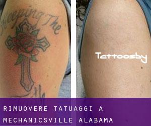 Rimuovere Tatuaggi a Mechanicsville (Alabama)