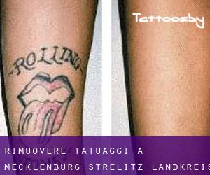 Rimuovere Tatuaggi a Mecklenburg-Strelitz Landkreis