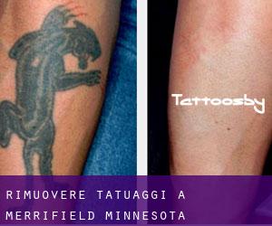 Rimuovere Tatuaggi a Merrifield (Minnesota)