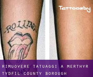 Rimuovere Tatuaggi a Merthyr Tydfil (County Borough)