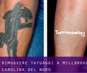 Rimuovere Tatuaggi a Millbrook (Carolina del Nord)