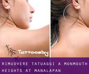 Rimuovere Tatuaggi a Monmouth Heights at Manalapan