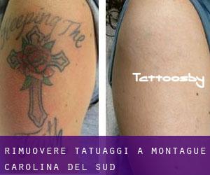 Rimuovere Tatuaggi a Montague (Carolina del Sud)