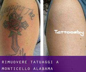 Rimuovere Tatuaggi a Monticello (Alabama)