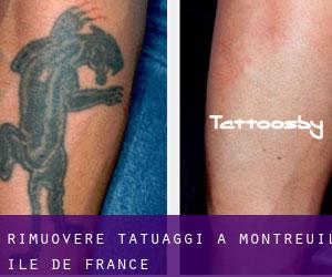 Rimuovere Tatuaggi a Montreuil (Île-de-France)