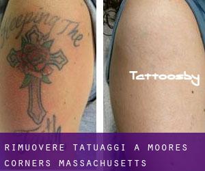 Rimuovere Tatuaggi a Moores Corners (Massachusetts)