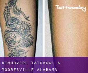 Rimuovere Tatuaggi a Mooresville (Alabama)