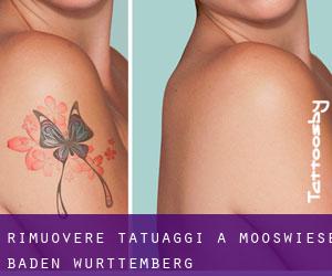 Rimuovere Tatuaggi a Mooswiese (Baden-Württemberg)