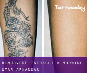Rimuovere Tatuaggi a Morning Star (Arkansas)
