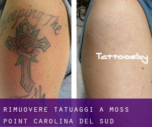 Rimuovere Tatuaggi a Moss Point (Carolina del Sud)