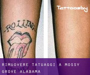 Rimuovere Tatuaggi a Mossy Grove (Alabama)
